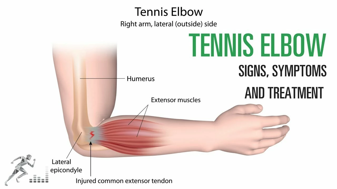 Is it okay to lift weights if I have tennis elbow?